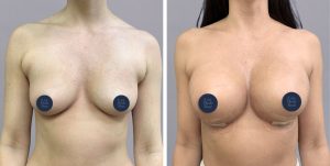 Breast Augmentation boob job before and after photo