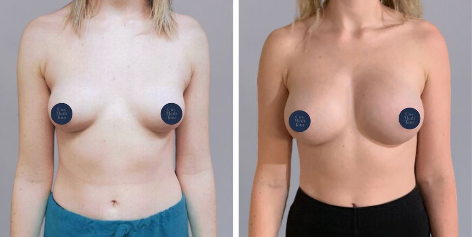 Breast Augmentation boob job before and after photo