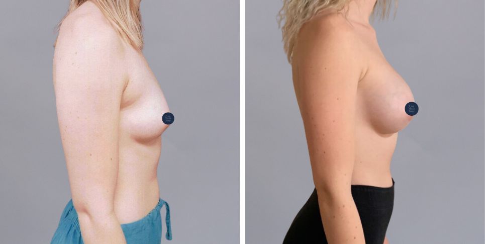 Breast Augmentation boob job before and after photo