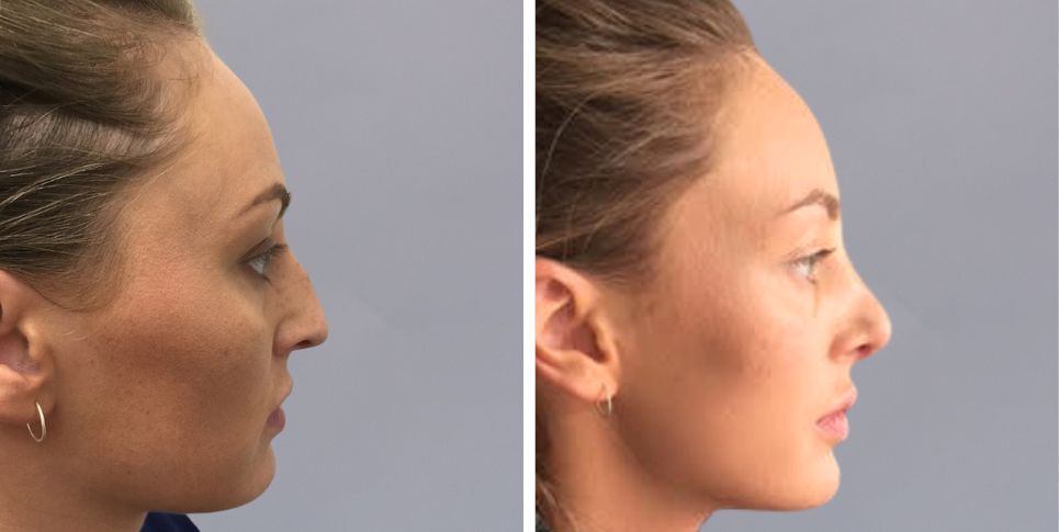 Rhinoplasty nose job before and after photo