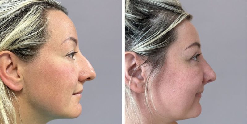 Rhinoplasty nose job before and after photo