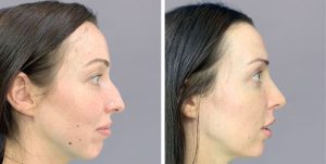 Rhinoplasty nose job before and after photo