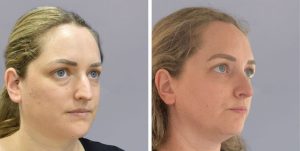 Rhinoplasty nose job before and after photo