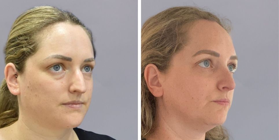 Rhinoplasty nose job before and after photo