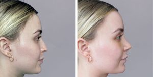 Rhinoplasty nose job before and after photo