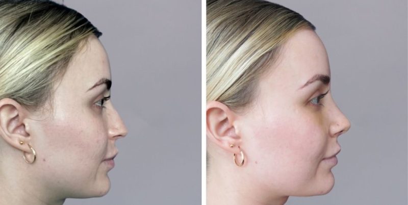 Rhinoplasty nose job before and after photo