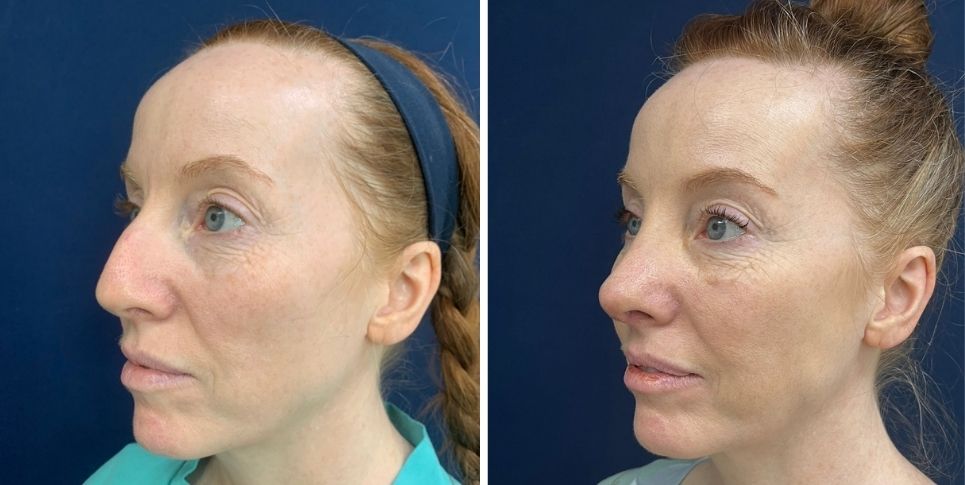 Rhinoplasty nose job before and after photo