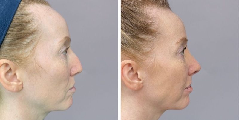 Rhinoplasty nose job before and after photo