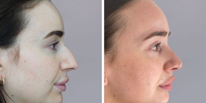 Rhinoplasty nose job before and after photo