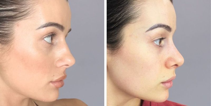 Rhinoplasty nose job before and after photo