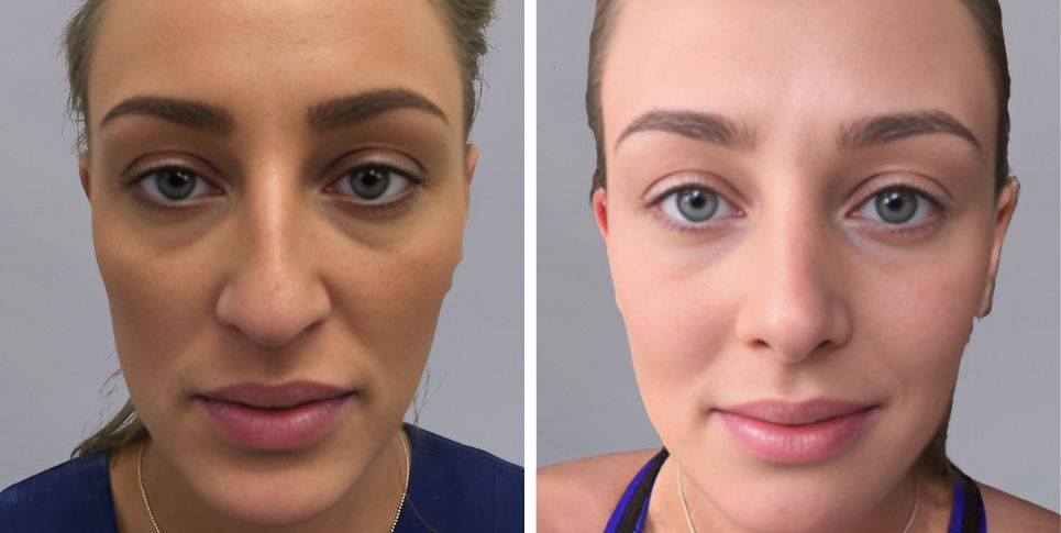 Rhinoplasty nose job before and after photo