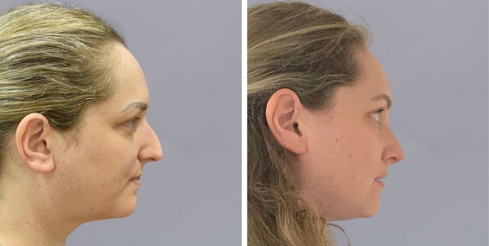 Rhinoplasty nose job before and after photo