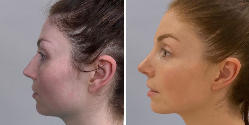 Rhinoplasty nose job before and after photo