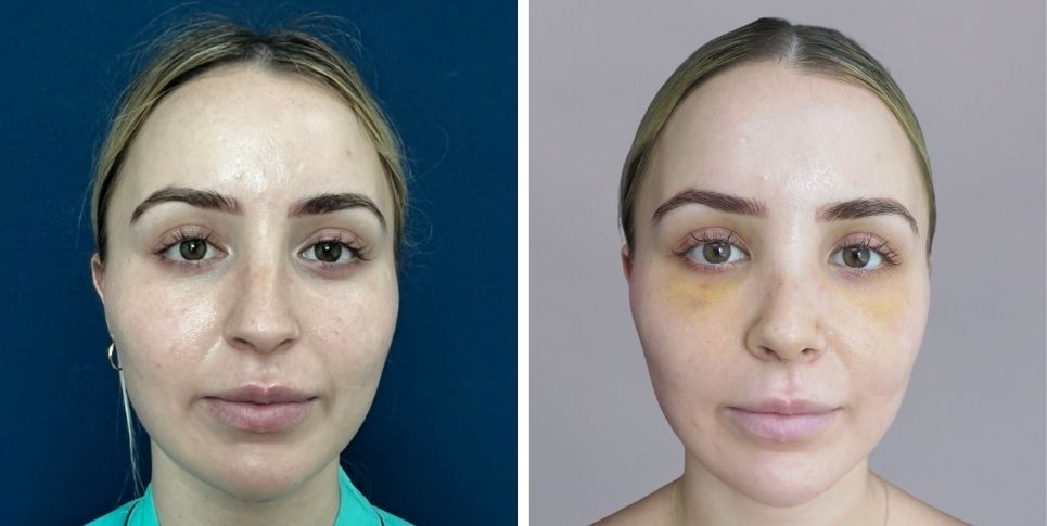 Rhinoplasty nose job before and after photo