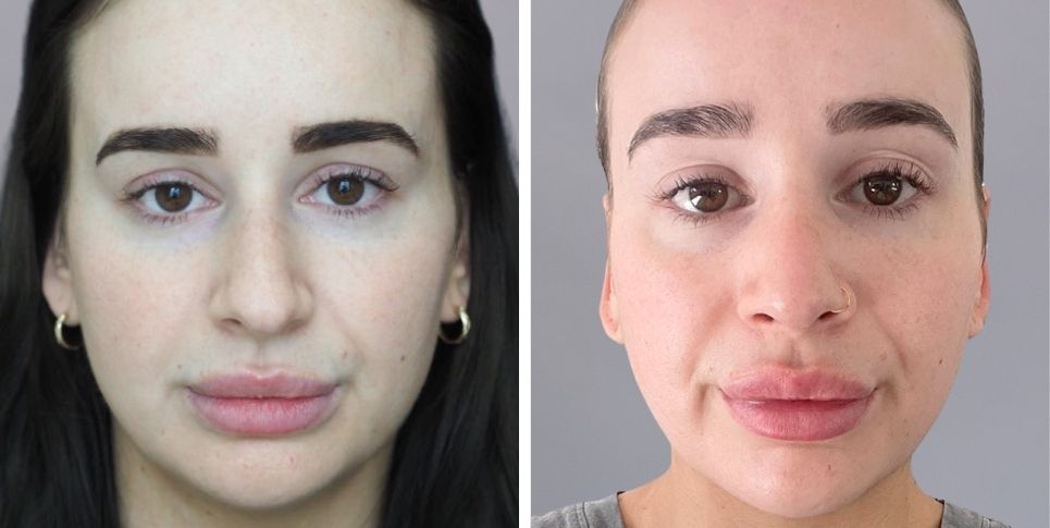 Rhinoplasty nose job before and after photo