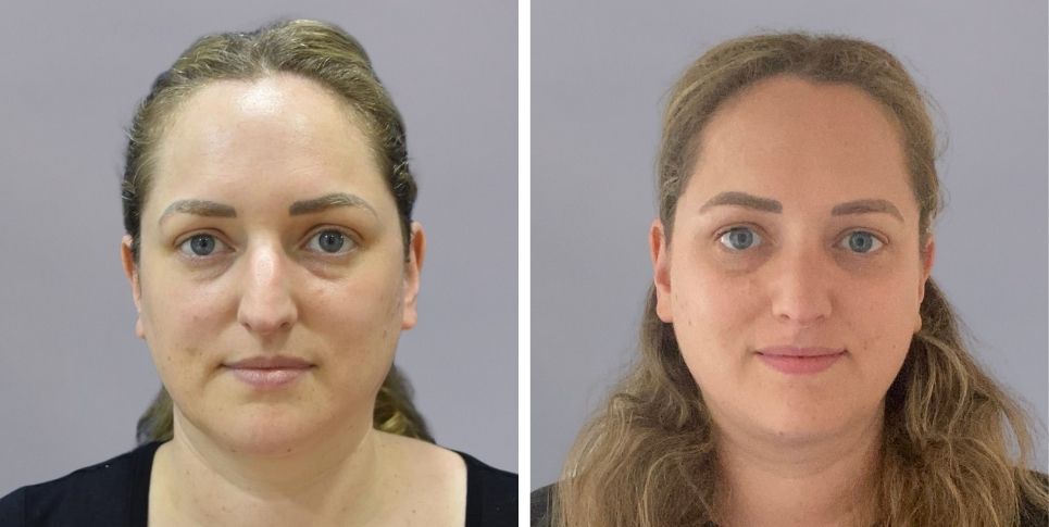 Rhinoplasty nose job before and after photo