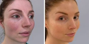 Rhinoplasty nose job before and after photo