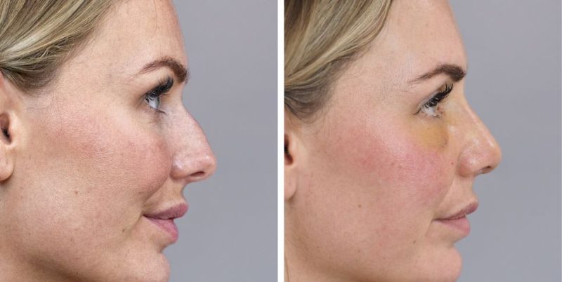 Rhinoplasty nose job before and after photo