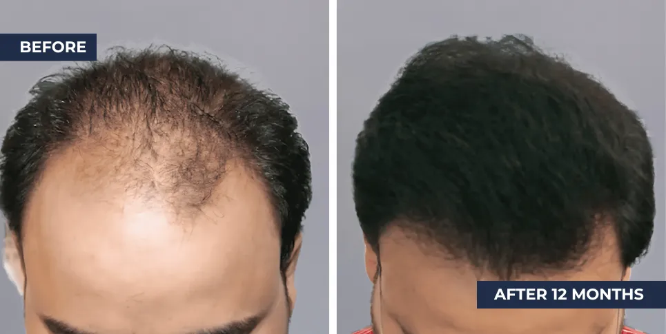 Hair Transplant Thailand