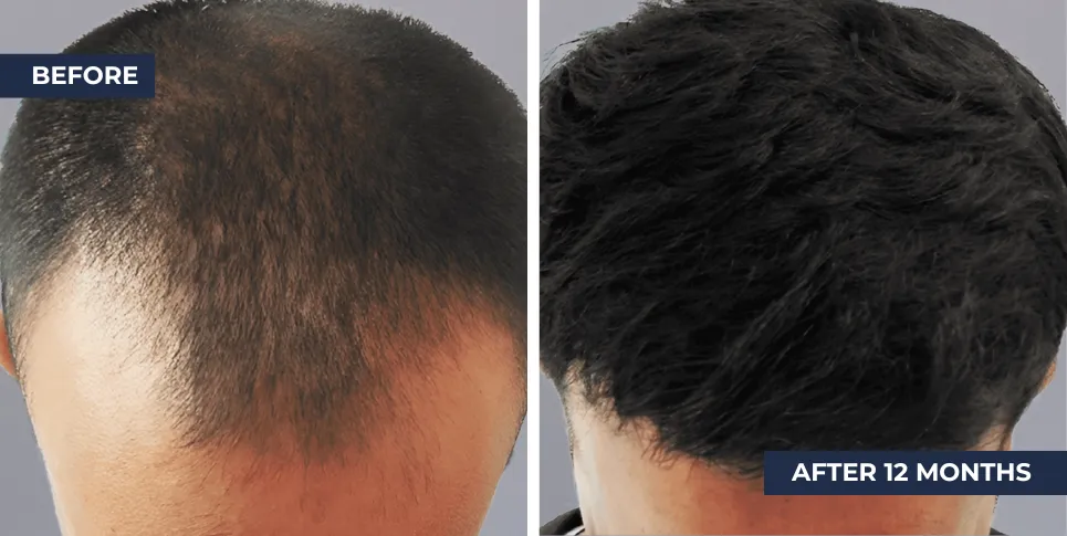 Hair Restoration Bangkok
