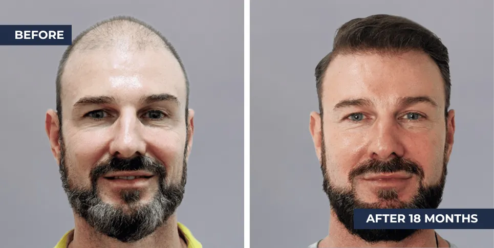 Thailand Male Hair Transplant