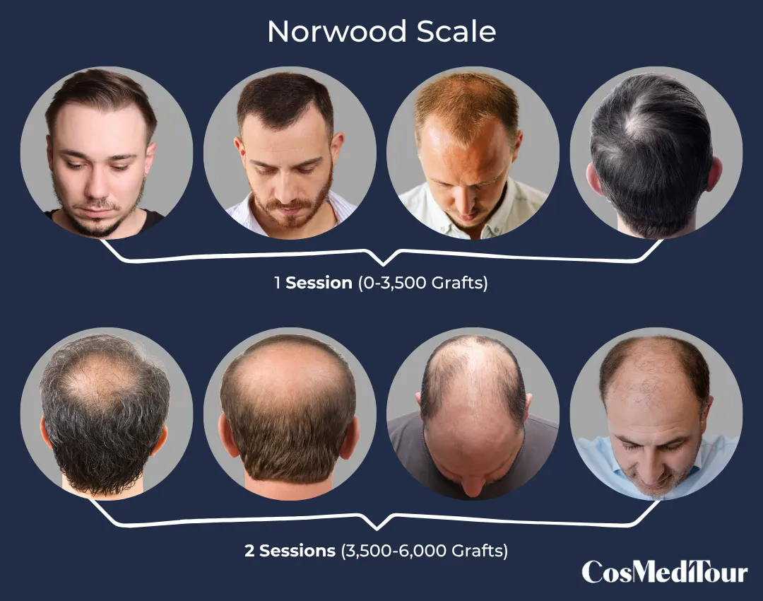 Norwood Scale CMT